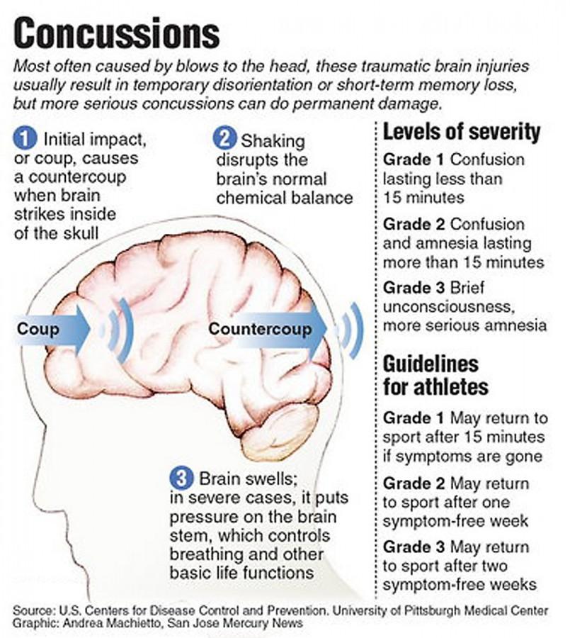 A diagram showing appropriate return times for athletes depending on the severity of their concussion.  