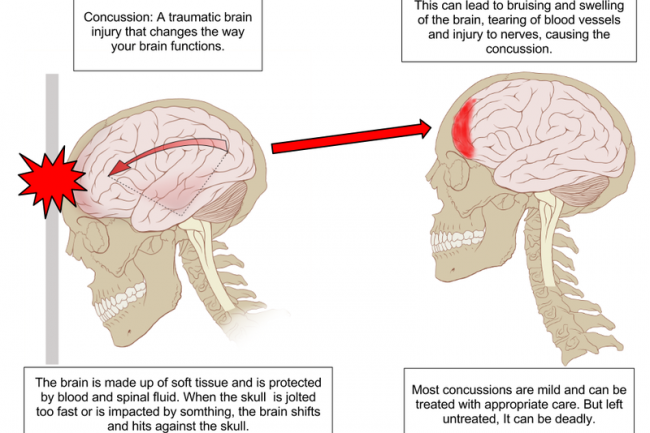 A+diagram+showing+what+happens+during+a+concussion.+